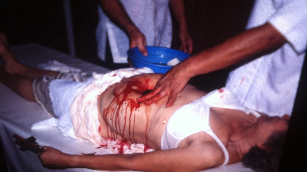 psychic surgery